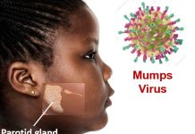 Mumps outbreak hits Keta in the Volta Region causes concern among residents